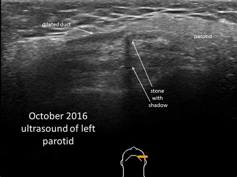 Parotid Gland Duct Ultrasound