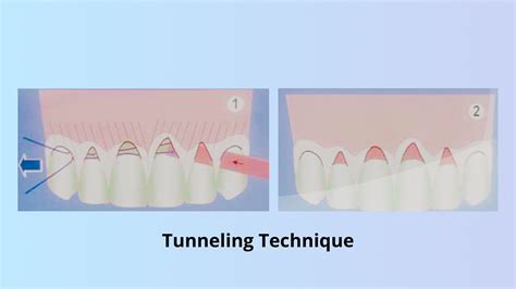 Connective tissue graft: The gold standard for root coverage