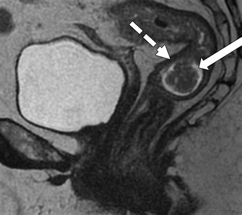 MRI of Rectal Cancer: Tumor Staging, Imaging Techniques, and Management ...