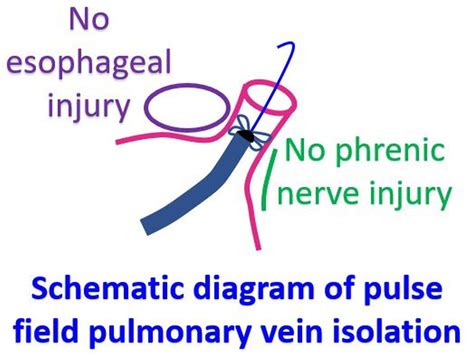 Pulsed field ablation - A novel treatment for heart rhythm disorders ...