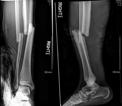 A 26-Year-Old Man with Disorientation Following Leg Fracture - JBJS ...