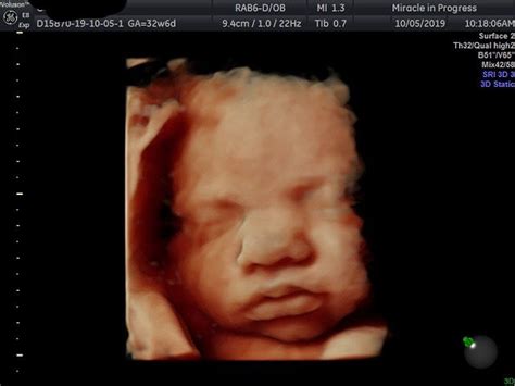 Tips & Tricks for a Successful 3D/4D 5D Ultrasound