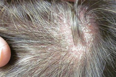 Discover 130+ hair scalp psoriasis - ceg.edu.vn