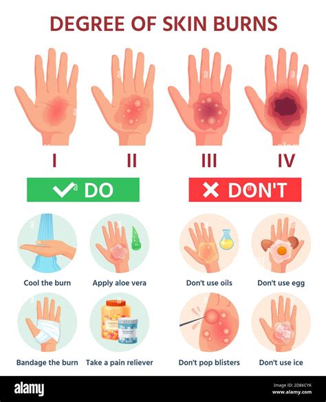 Burns degree. First aid for burn wound. Fire damage to skin classification. Hand blisters ...