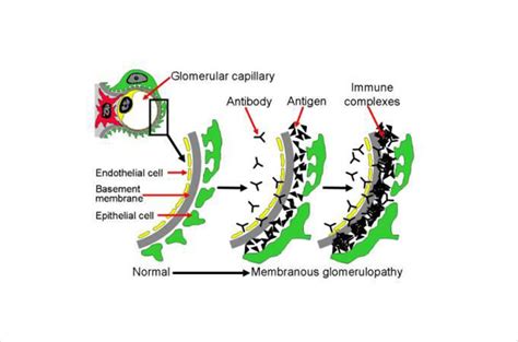 Membranous Nephropathy | UNC Kidney Center