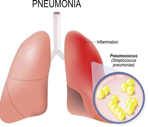 Pneumonia with Streptococcus pneumoniae | Allergy and Clinical