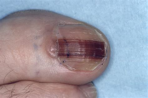 Nail Apparatus Melanoma Features Good Survival and Functional Outcome - Dermatology Advisor