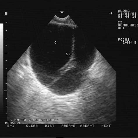 Theca lutein cysts in a 36 years old patient, with past history of a... | Download Scientific ...