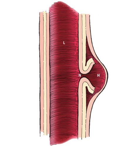 Pseudoaneurysm Formation and Repair After Mohs Micrographic Surgery: A Report of 3 Cases ...