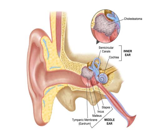 Mastoidectomy – Conditions & Treatments | SingHealth