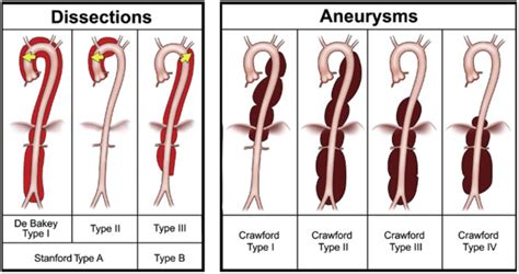 Thoracic Aortic Aneurysm - dlaczego-akurat-my