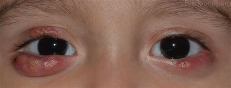 Chalazion causes, chalazion symptoms, surgery & chalazion treatment at home