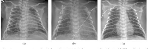 Meconium Aspiration Syndrome X Ray