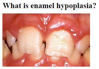 kRes8-Enamel Hypoplasia - dentist Appleton WI - Dental Haven - Dr Gonzalo and Dr Alexandra Hernandez