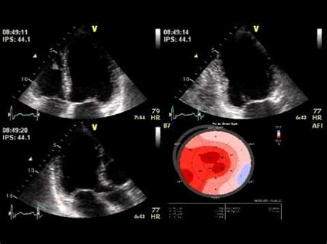 DOBUTAMINE STRESS ECHO MITRAL REGURGITATION / ECHOCARDIOGRAPHY cardiac ...