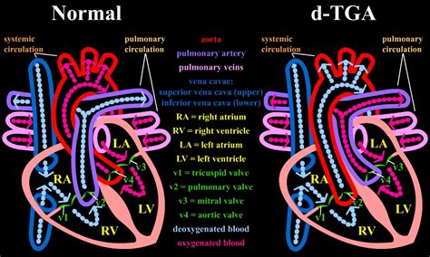 Dextro-transposition of the great arteries pathophysiology - wikidoc