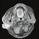 Result of maxillofacial MRI: Right external ear canal obstruction, size... | Download Scientific ...