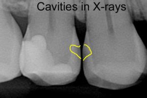 Early Cavity Xray