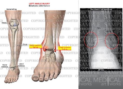 Left ankle bimalleolar fracture with injury x-ray — Medical Art Works