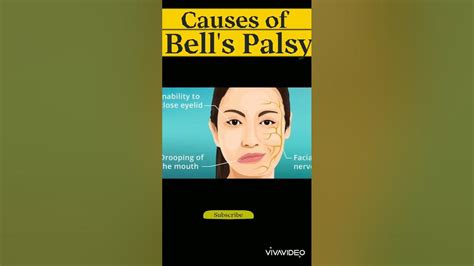 What causes Bell's Palsy?/Justin Bieber Bell's Palsy/Shorts - YouTube