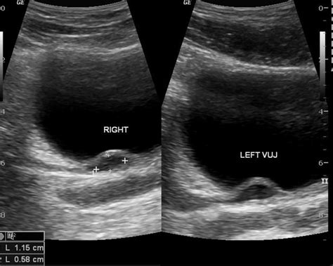 Ureterocele Cobra Head Sign