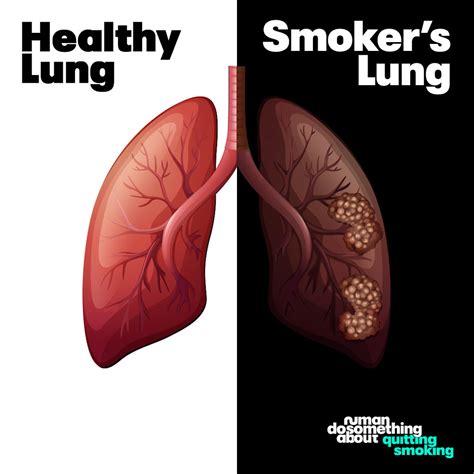 Smokers lungs before/ after quitting smoking | Comparison of… | Flickr