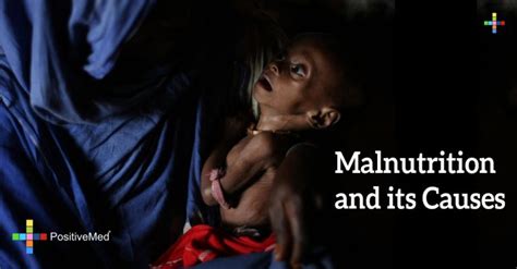 Malnutrition and its Causes - PositiveMed