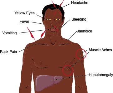 Yellow Fever Virus - Creative Diagnostics