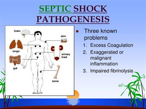 PPT - SEPTIC SHOCK PowerPoint Presentation, free download - ID:1715724