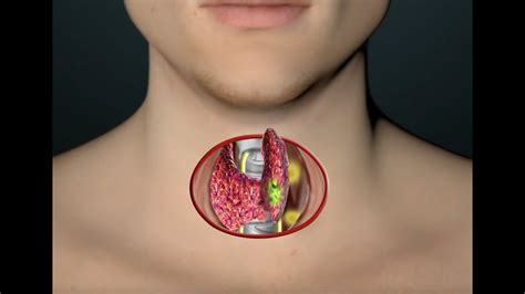 thyroid surgery - YouTube