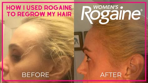 Rogaine for Women Before and After - YouTube