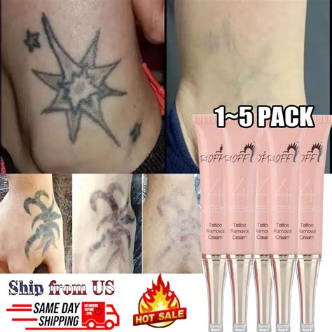 Details 79+ tattoo removal cream philippines super hot - in.coedo.com.vn