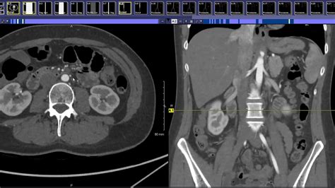 How to read an Aortic Runoff - YouTube