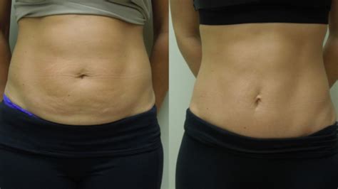 Tummy Tuck with Muscle Repair and Lipo - Cosmetic Surgery Tips