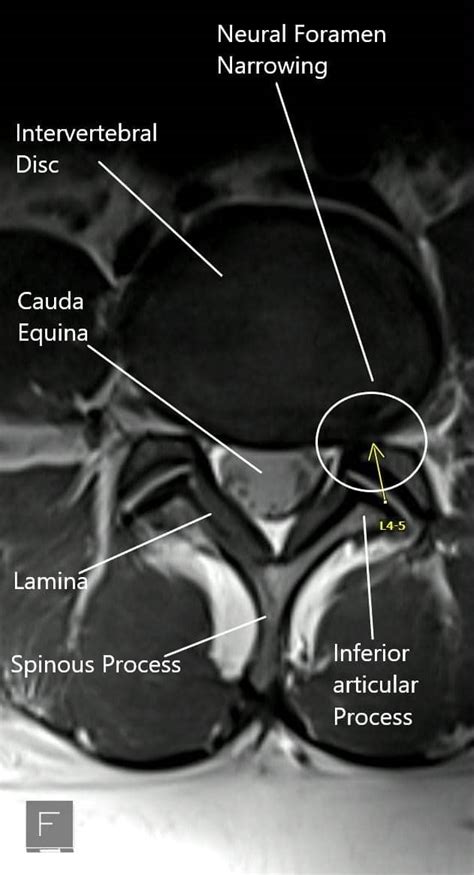 Sciatica - Causes - Complete Orthopedics & Podiatry | Multiple NY Locations