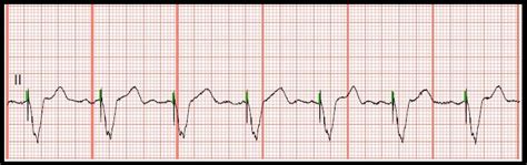 Practice EKG Rhythm Strips 118