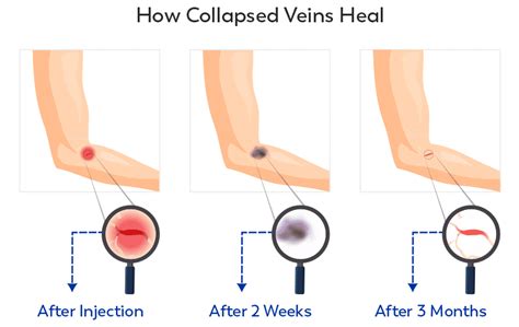 Collapsed Vein | Symptoms, Causes, Treatments, And Prevention