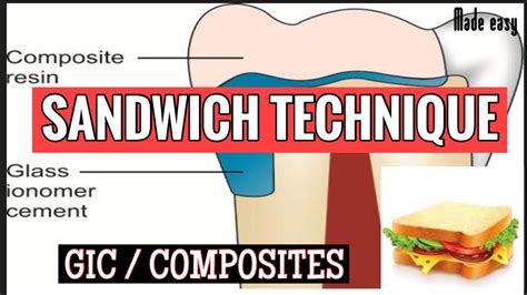 SANDWICH TECHNIQUE II COMPOSITE AND GLASS IONOMER CEMENT II DENTAL MATERIALS - YouTube