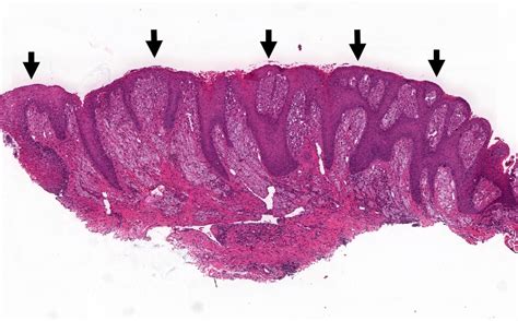 Xanthoma Histology