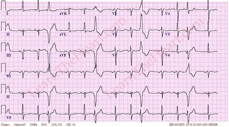 Trigeminal Premature Ventricular Contractions