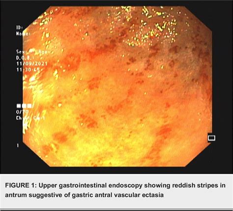 Figure 1 from Gastric Antral Vascular Ectasia as the First Presentation of Primary Biliary ...