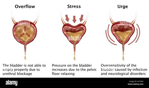 Illustration depicting three types of incontinence: overflow, stress, and urge. Overflow ...