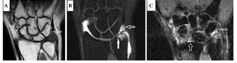 Case of split tear of the ulnotriquetral ligaments with peripheral tear... | Download Scientific ...