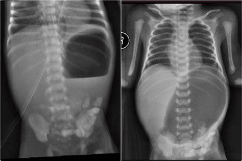 Cureus | Hereditary Multiple Intestinal Atresia: A Case Report and Review of the Literature