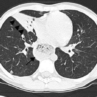 (PDF) Obstructive bronchitis and recurrent pneumonia in esophageal achalasia in a child: A CARE ...