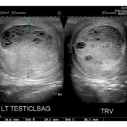 Scrotal Anatomy Ultrasound