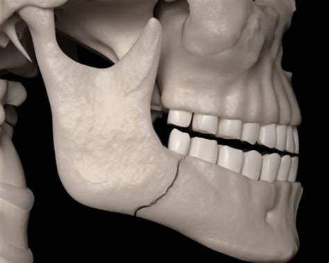 Maxilla and Mandible Fracture Treatments | Happy Dental and General Health Care