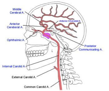 Teach Neurology: Anterior choroidal artery syndrome