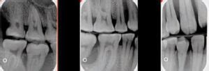 Techniques to Enhance Radiographic Utility - Decisions in Dentistry