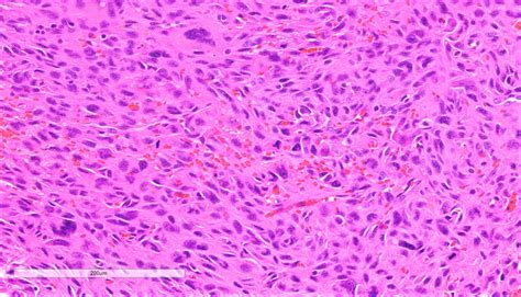 Pathology Outlines - Atypical fibroxanthoma